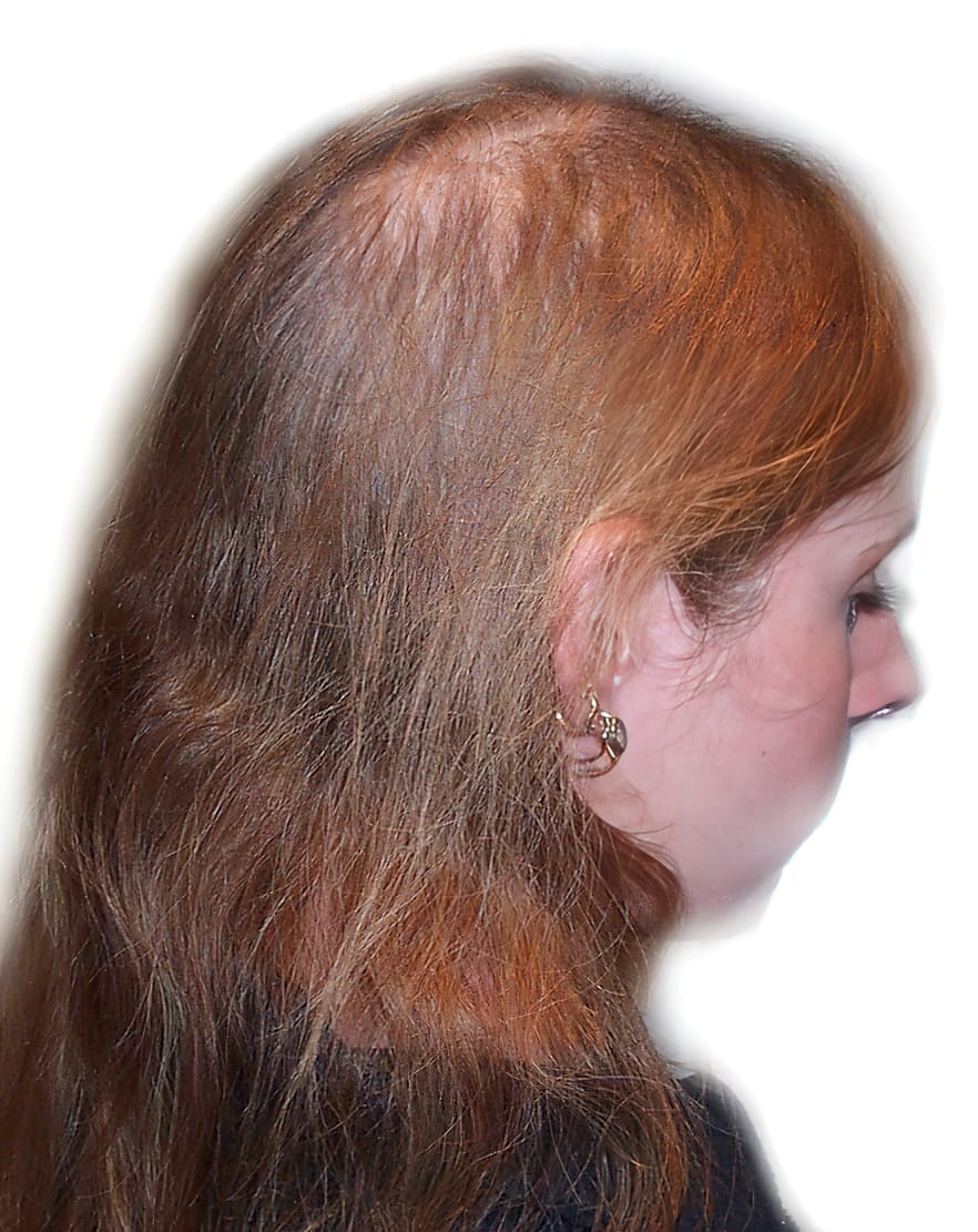 Before Picture - Androgenetic Alopecia Cosmetic Cover-Up